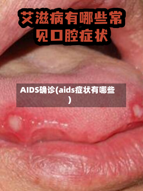 AIDS确诊(aids症状有哪些)-第3张图片