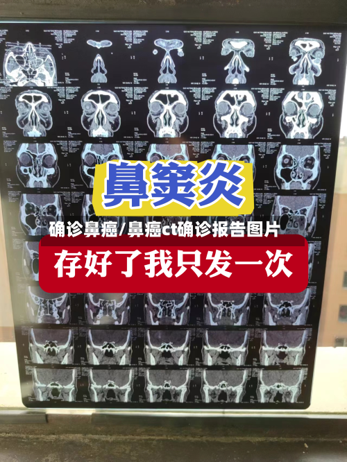 确诊鼻癌/鼻癌ct确诊报告图片