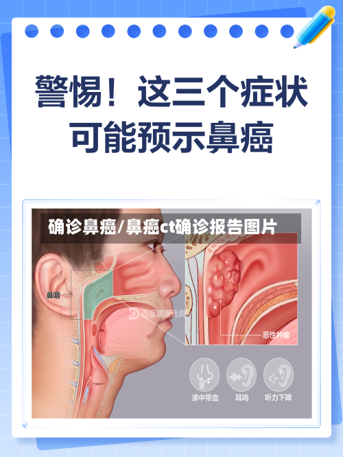 确诊鼻癌/鼻癌ct确诊报告图片-第2张图片