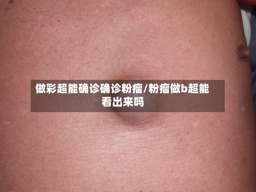做彩超能确诊确诊粉瘤/粉瘤做b超能看出来吗-第3张图片