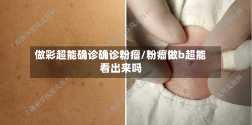 做彩超能确诊确诊粉瘤/粉瘤做b超能看出来吗