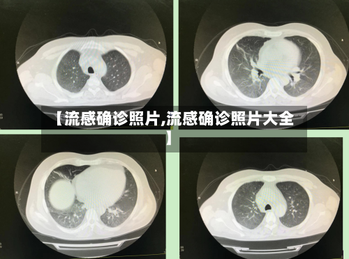 【流感确诊照片,流感确诊照片大全】-第2张图片